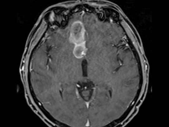 Acute Headache: Helping to Rule Out a Subarachnoid Hemorrhage ...