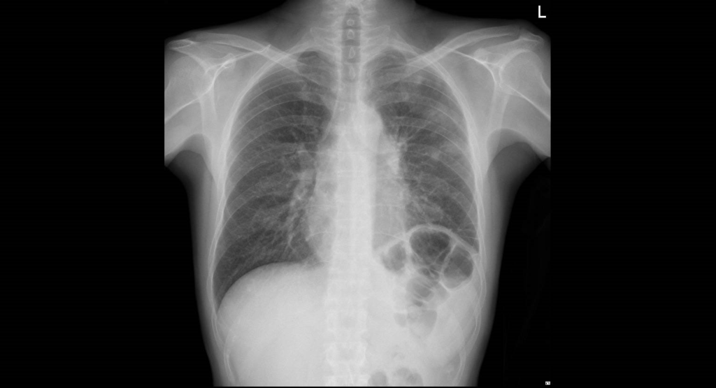 why-do-i-have-shortness-of-breath-is-it-my-non-hodgkin-lymphoma